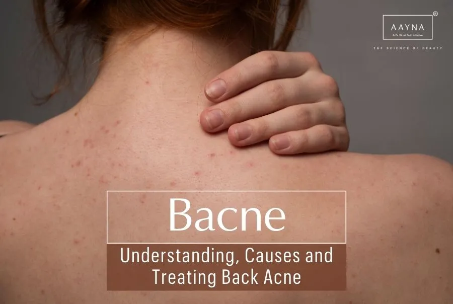 Bacne: Understanding, Causes and Treating Back Acne