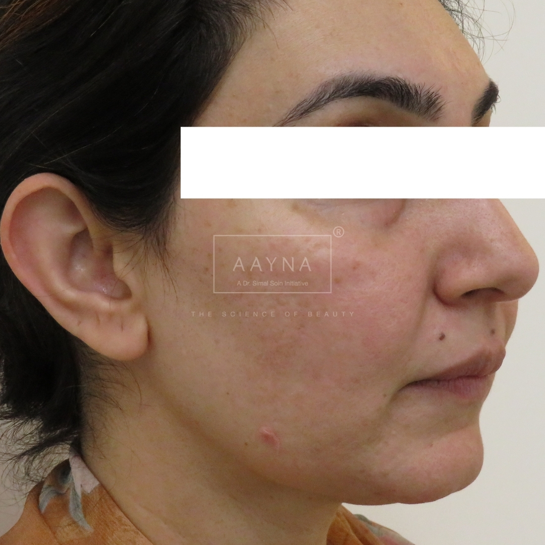 before-img
