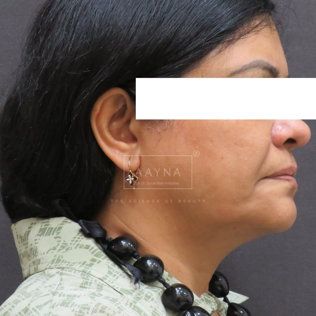 before-img