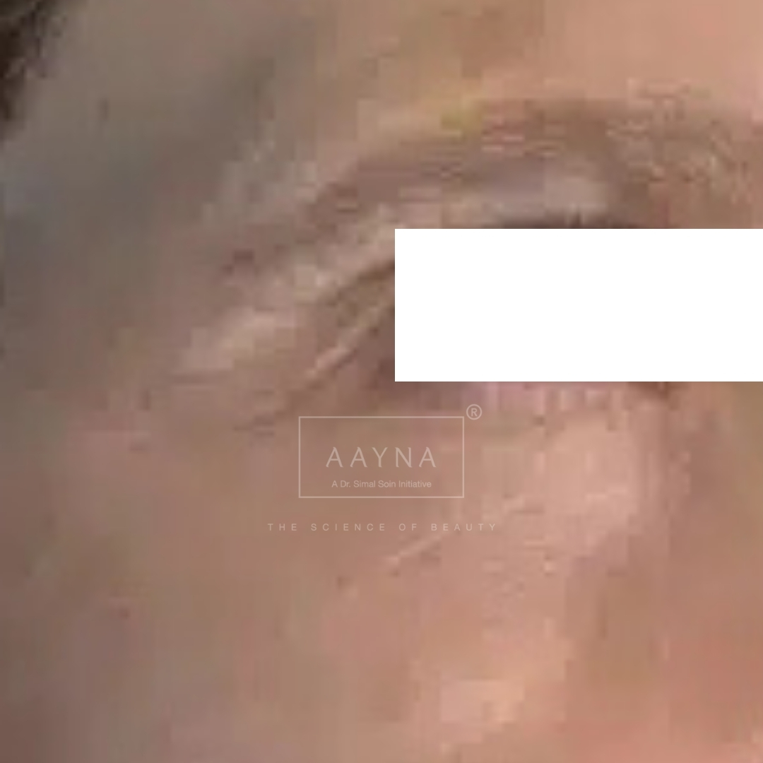 after-img