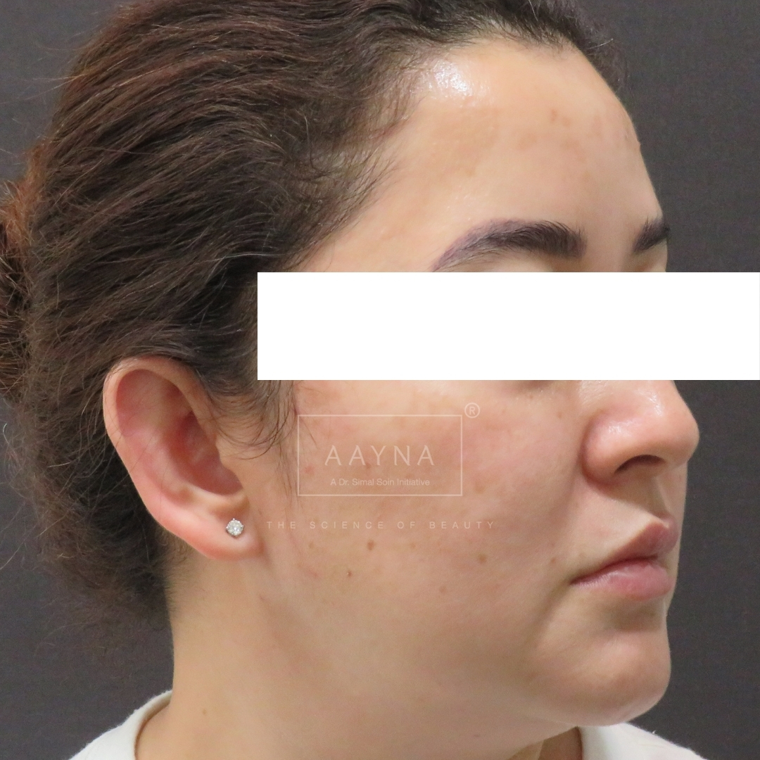 before-img