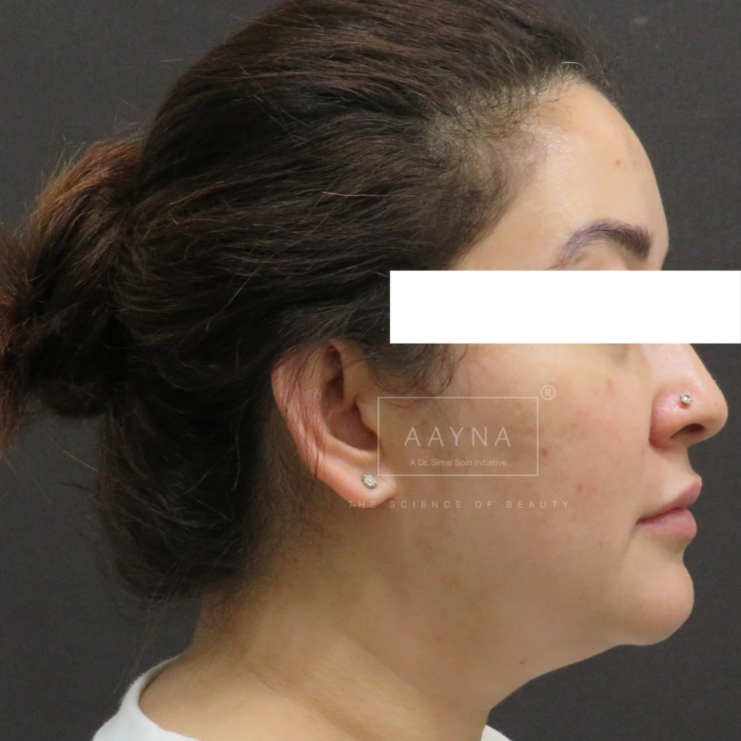 after-img