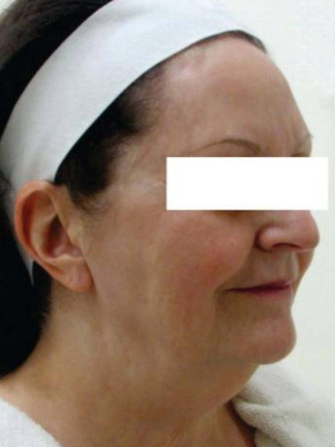 before-img