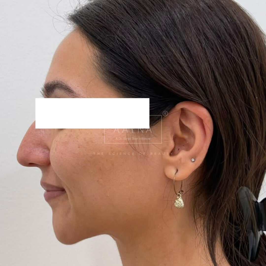 before-img