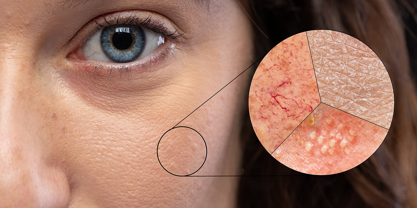 Enlarged Open Pores: Types, Treatment and Causes