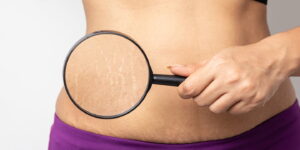 Lifestyle Changes to Minimize and Prevent Stretch Marks