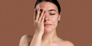 How to Prevent Acne: 8 Tips to Reduce Pimples