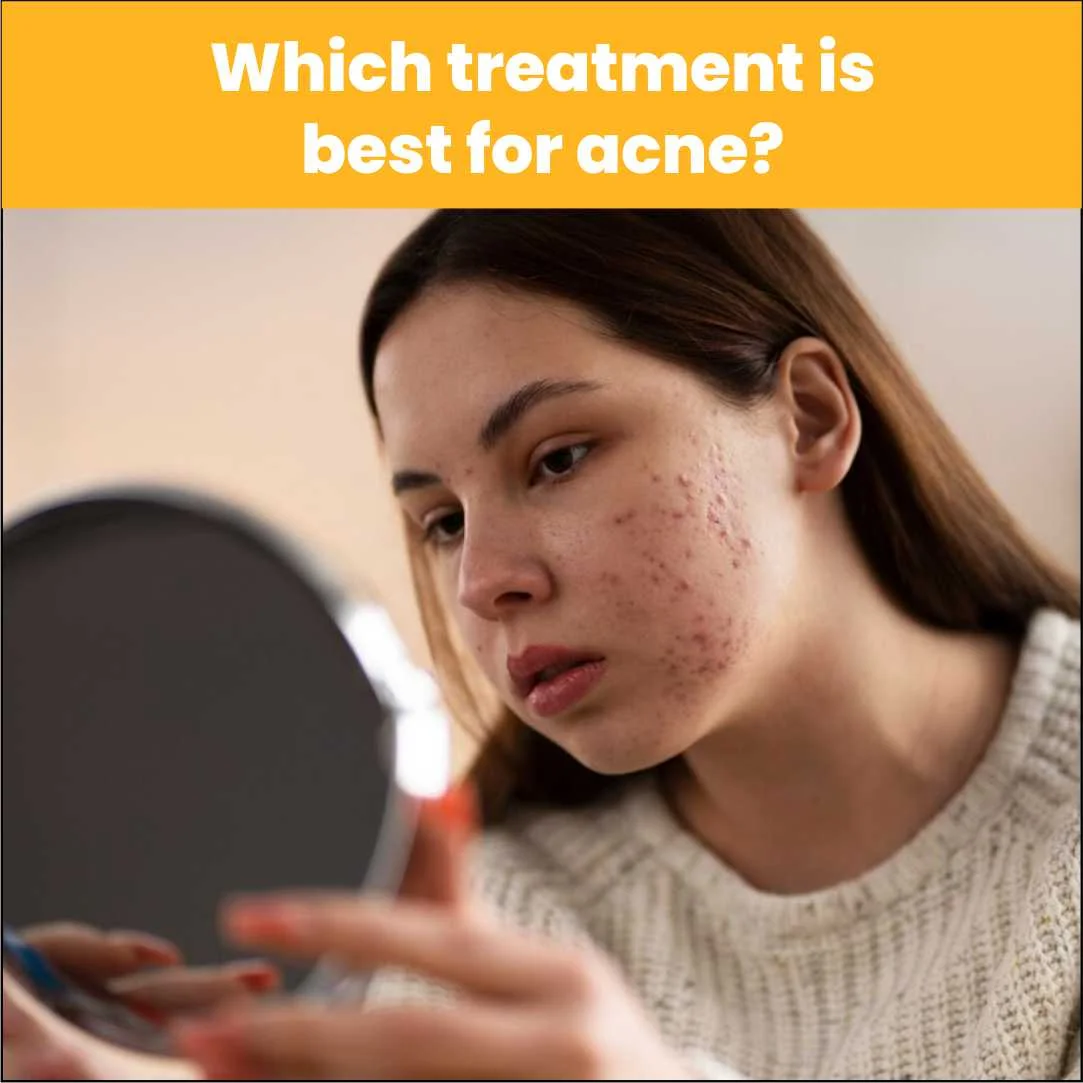 Which Treatment is Best for Acne – AAYNA Clinic’s Guide to Clear Skin