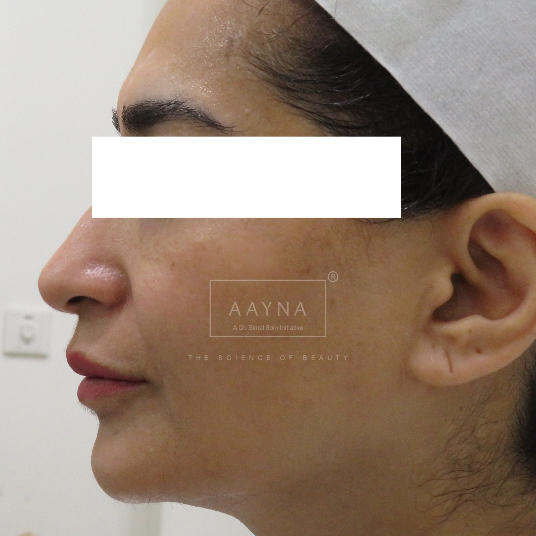 before-img