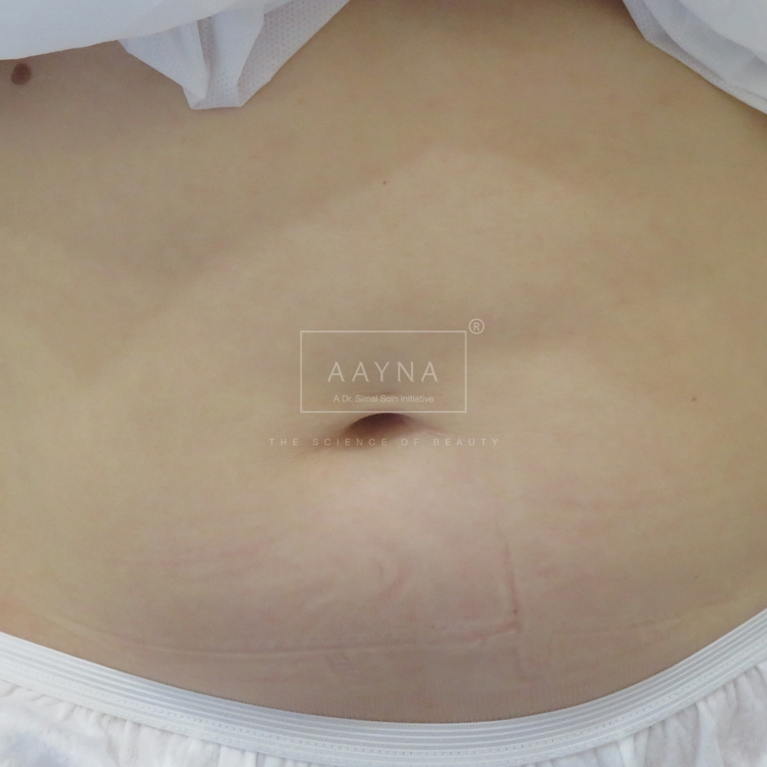 after-img