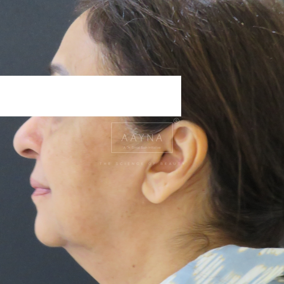 before-img