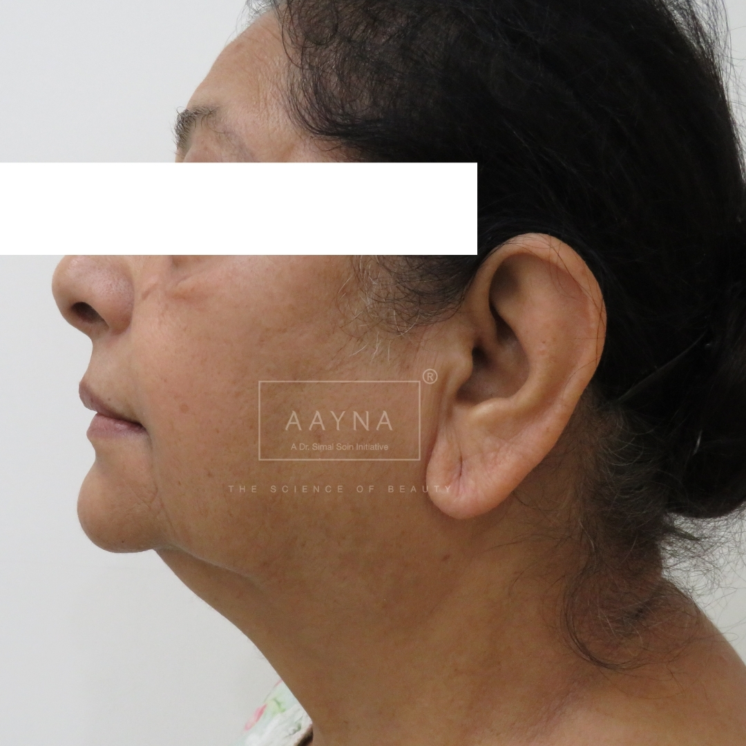 before-img