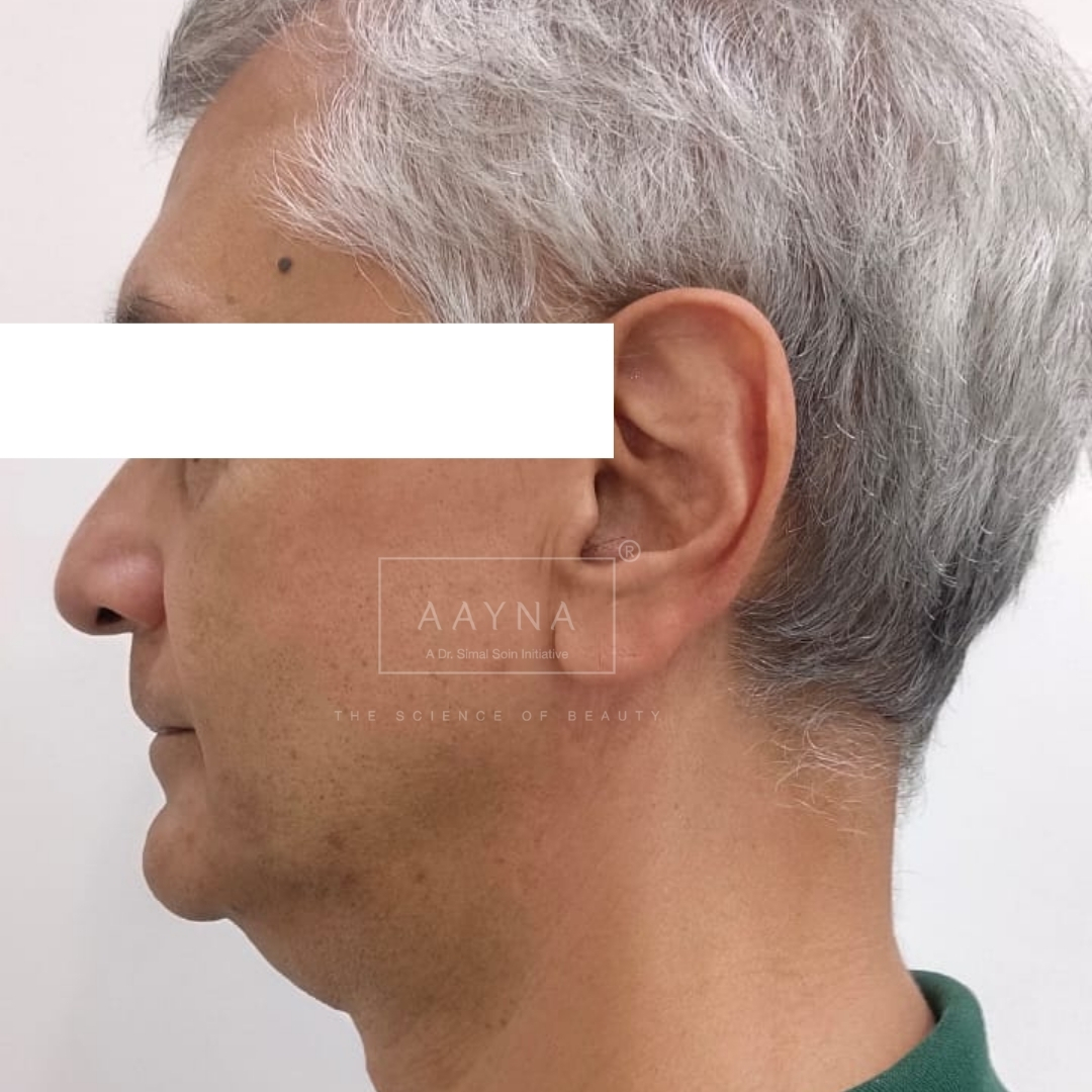 before-img
