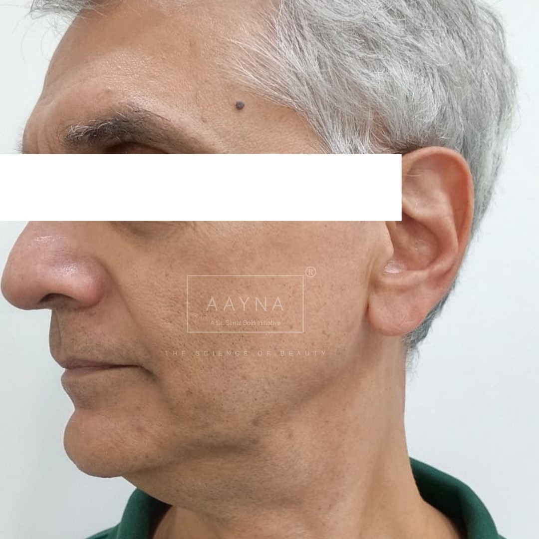 after-img