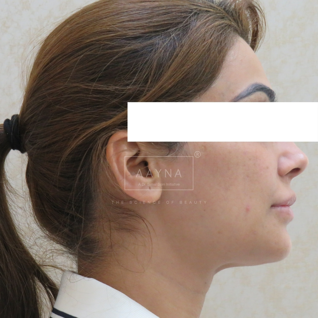 before-img