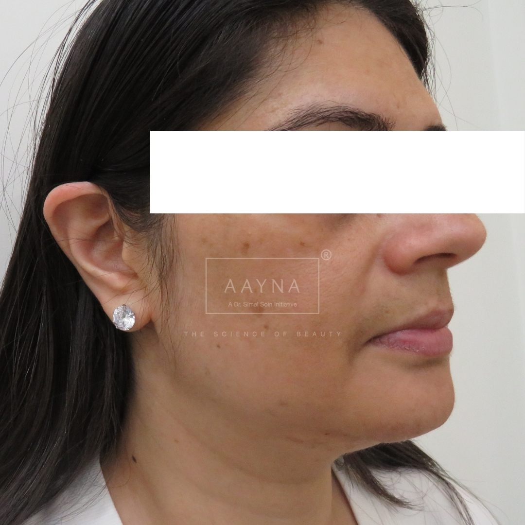 before-img
