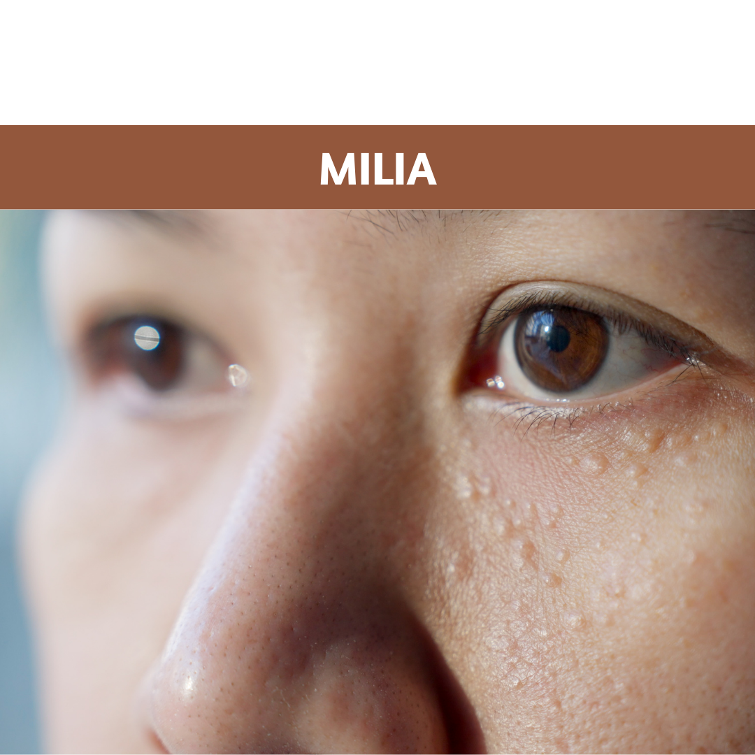 Milia 101: Meaning, Causes, Treatments and FAQs