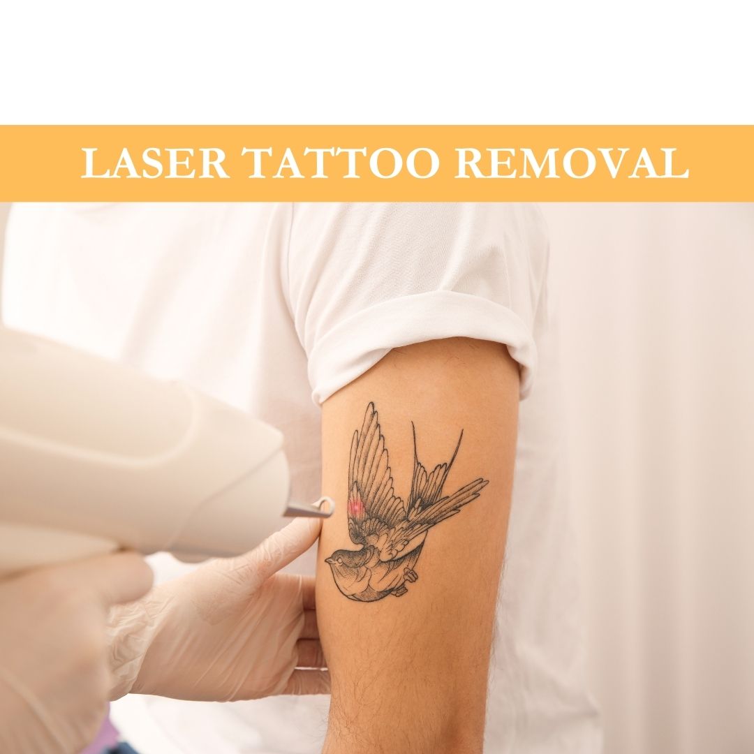 Laser Tattoo Removal: A Fresh Start for Your Skin