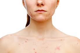 Dermatologist-Approved: 9 Ways to Beat Chest Acne