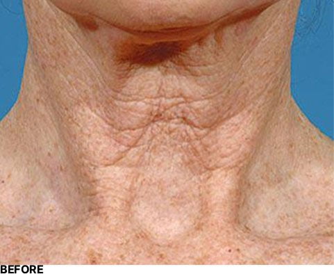 Turkey Neck – No Thanks